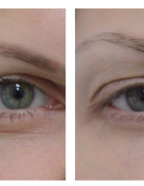 Инъекции Ботокс вокруг глаз: фото до и после